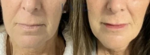 Lip Filler Client 2