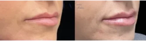 Lip Filler Before & After