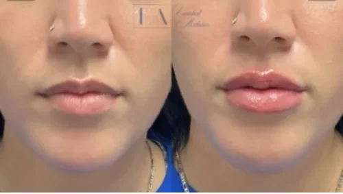 Lip Filler Client 4