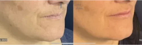Lip Filler Client 2