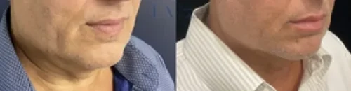 Lip Filler: Men Get Filler Too