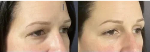 Under Eye Hollows