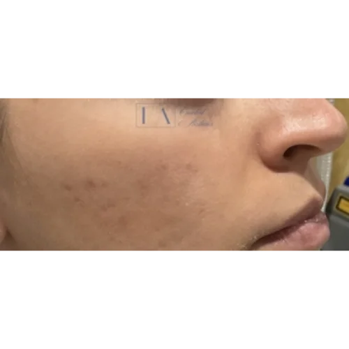 Acne Scar Before & After