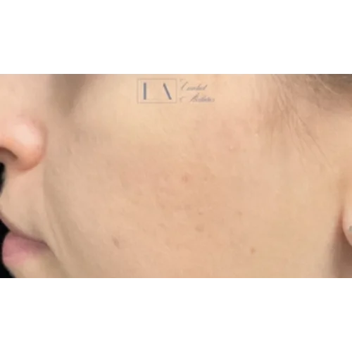 Acne Scar Before & After