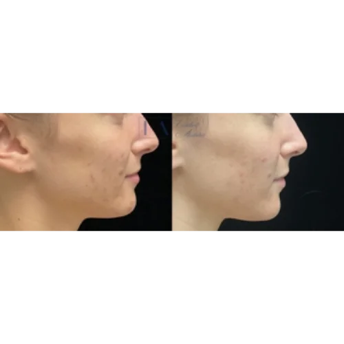 Acne Scar Before & After