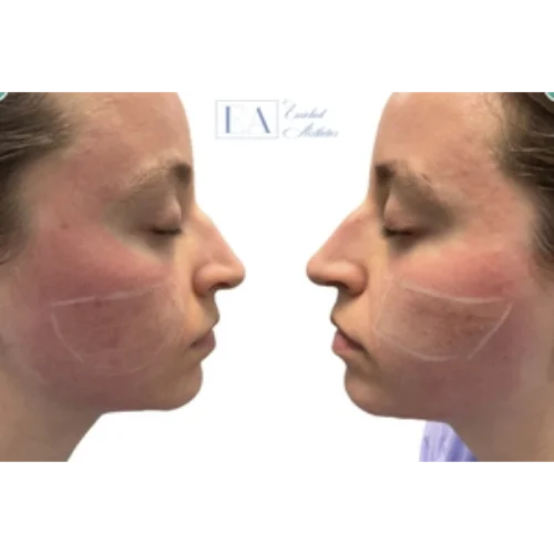 Acne Scar Before & After