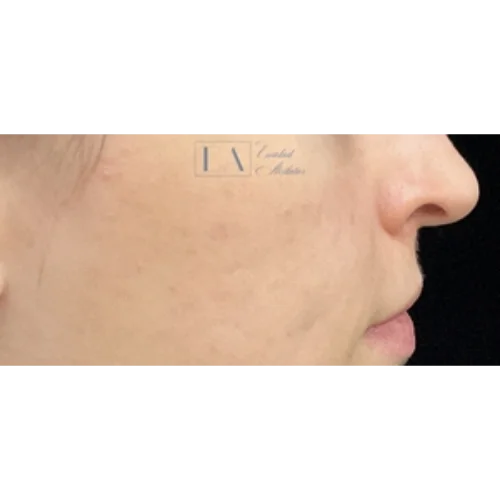 Acne Scar Before & After