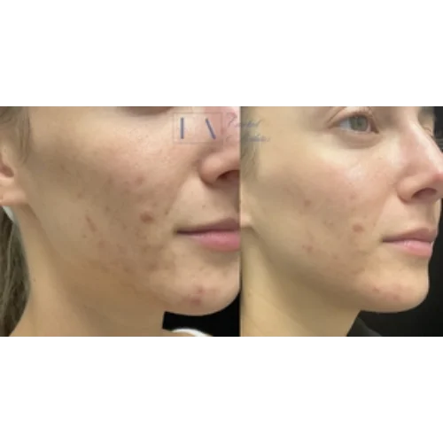 Acne Scar Before & After