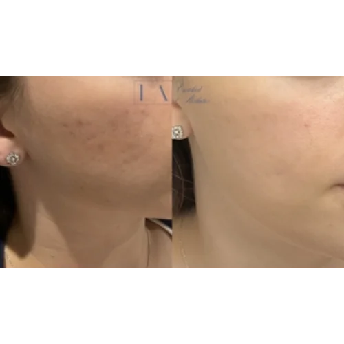 Acne Scar Before & After