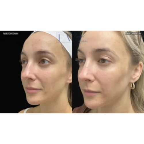 Acne Scar Before & After