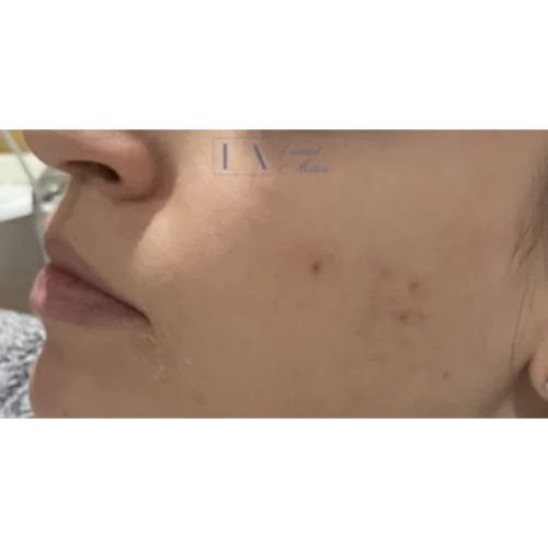 Acne Scar Before & After