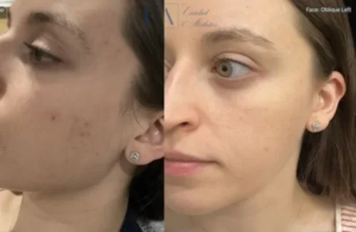 Acne Scar Before & After