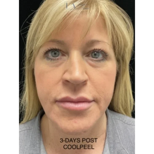 CoolPeel Skin Resurfacing Laser Treatment