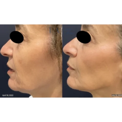 CoolPeel Skin Resurfacing Laser Treatment
