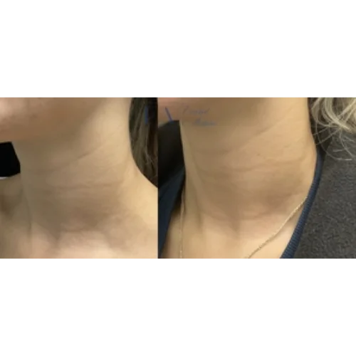 CoolPeel Skin Resurfacing Laser Treatment