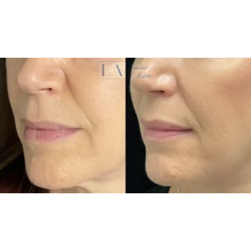 CoolPeel Skin Resurfacing Laser Treatment