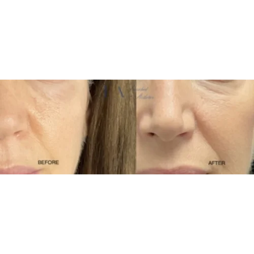 CoolPeel Skin Resurfacing Laser Treatment