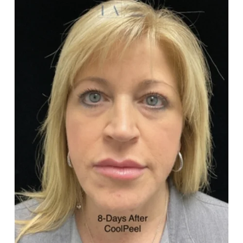 CoolPeel Skin Resurfacing Laser Treatment