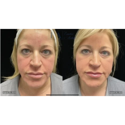 CoolPeel Skin Resurfacing Laser Treatment