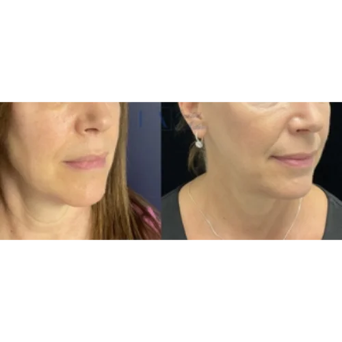 CoolPeel Skin Resurfacing Laser Treatment