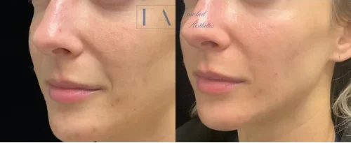 CoolPeel Skin Resurfacing Laser Treatment