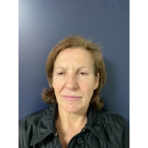 TETRA CO2 Laser Treatment: Client 2