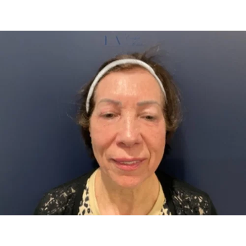 TETRA CO2 Laser Treatment: Client 2