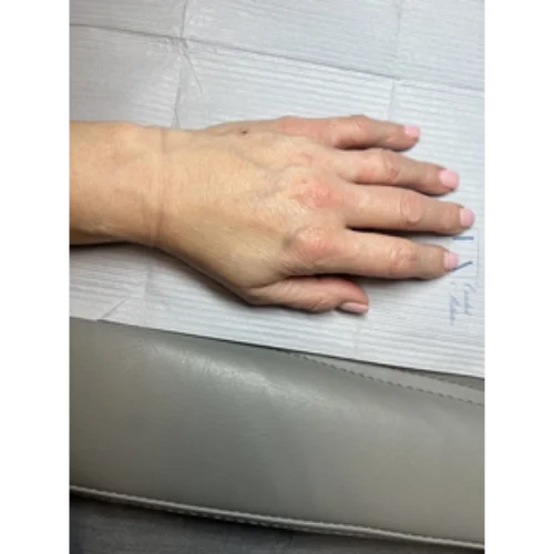 CoolPeel Hand Treatment