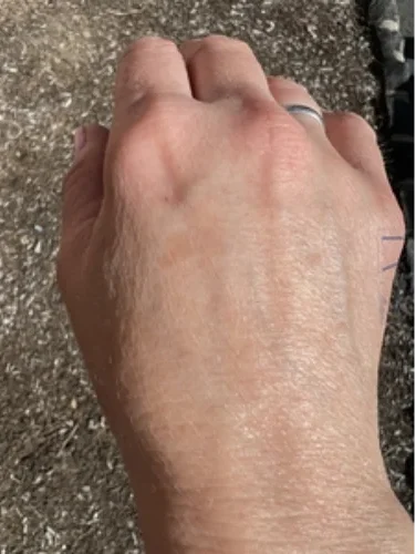 CoolPeel Hand Treatment