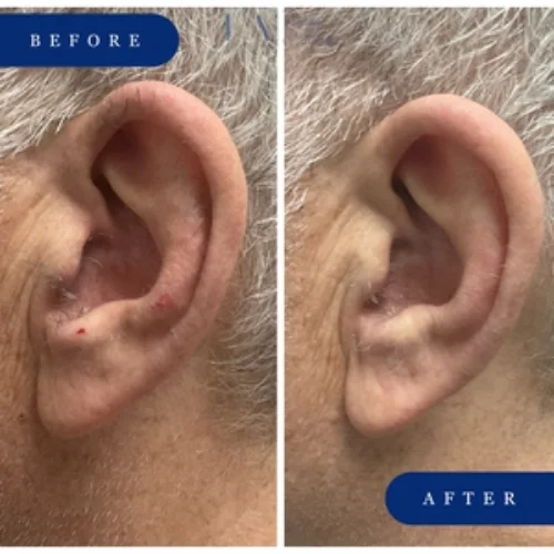 Enriched Aesthetics Ear Hair-Laser Hair Reduction image a