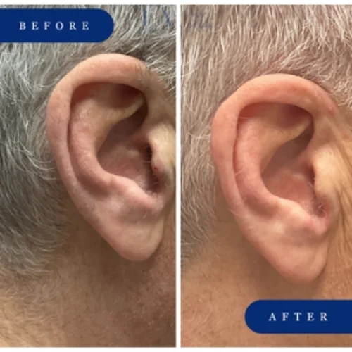 Enriched Aesthetics Ear Hair-Laser Hair Reduction image b