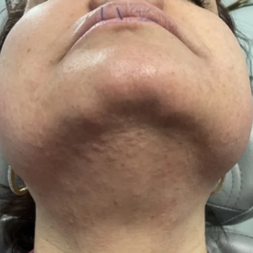 Enriched Aesthetics Facial Laser Hair Reduction Results image a