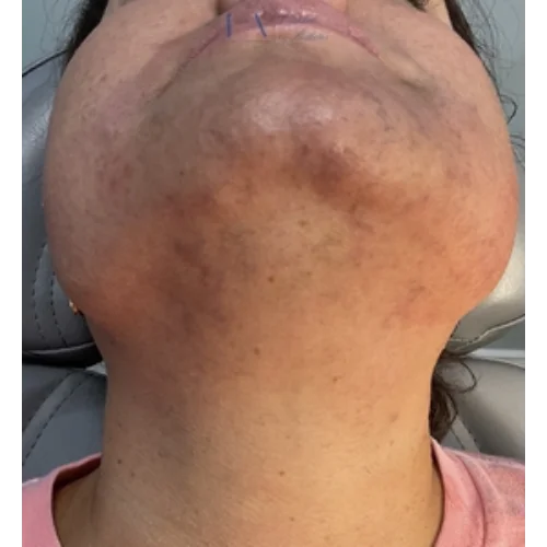 Enriched Aesthetics Facial Laser Hair Reduction Results image b