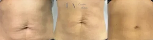 Enriched Aesthetics The TruBody Experience in Body Contour image a