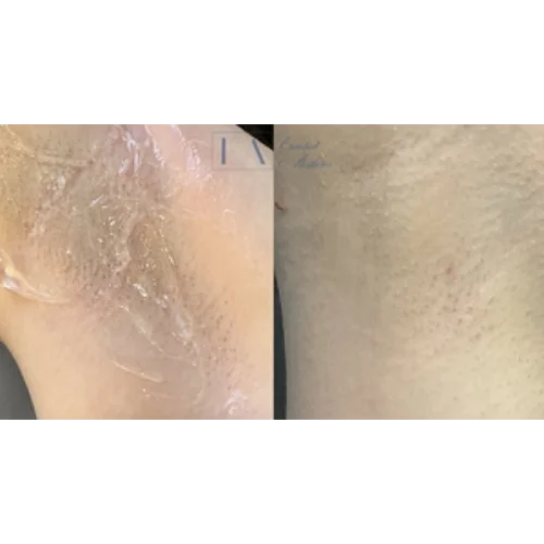 Enriched Aesthetics Under Arm Laser Hair Reduction image a