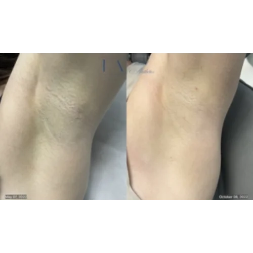 Enriched Aesthetics Under Arm Laser Hair Reduction image b