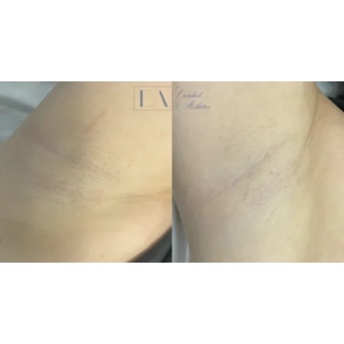 Enriched Aesthetics Under Arm Laser Hair Reduction image c