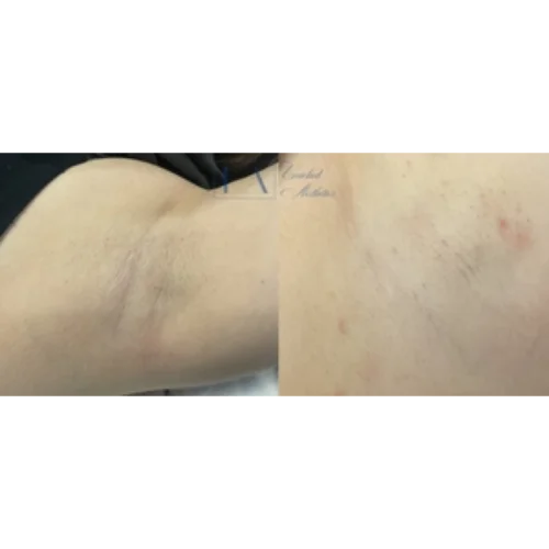 Enriched Aesthetics Under Arm Laser Hair Reduction image d